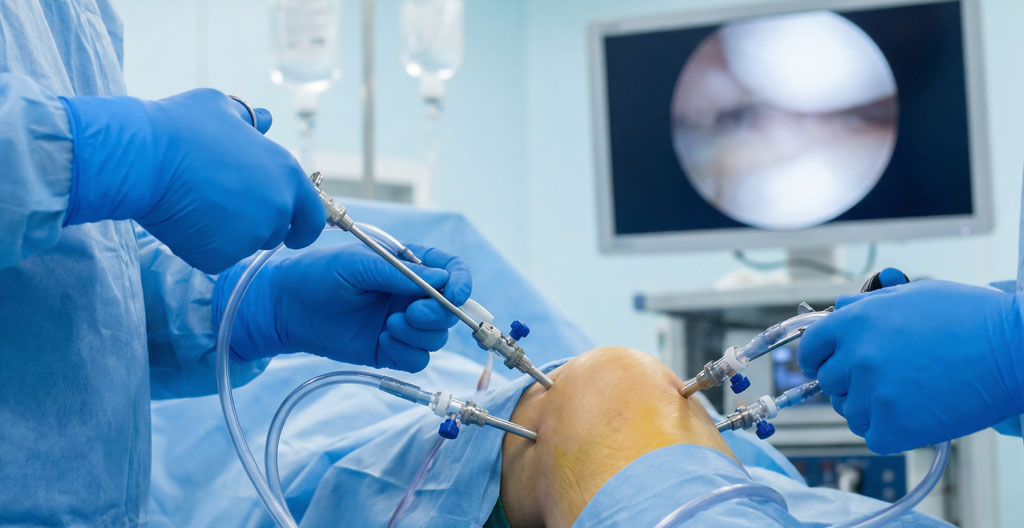 Vue d'ensemble d'une intervention arthroscopique du genou en salle opératoire
